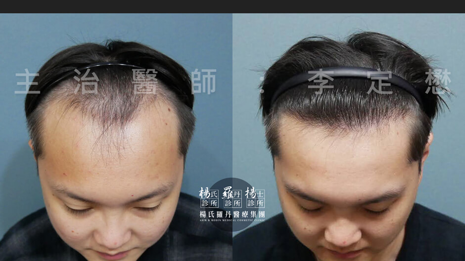 植髮 髮際線 禿頭 植髮效果