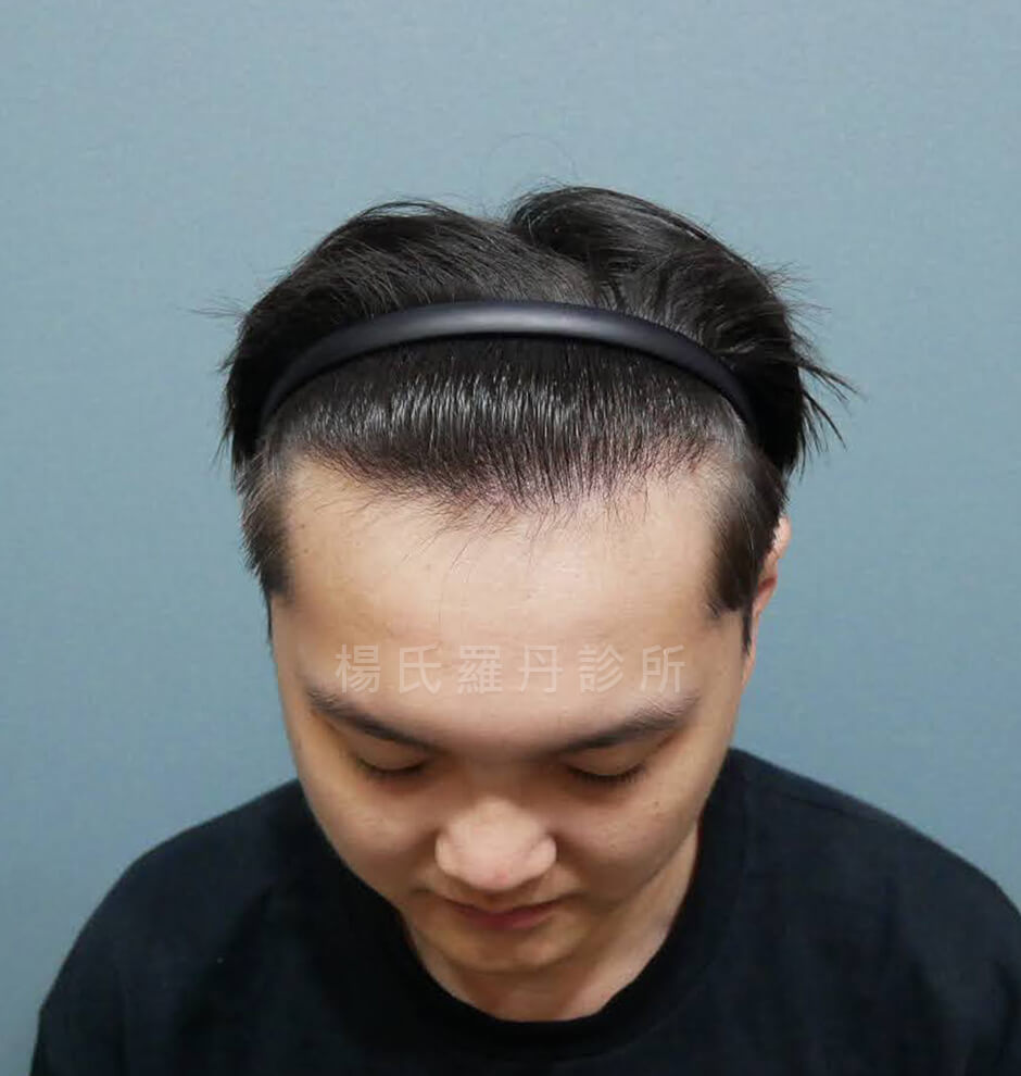 植髮 植髮效果 