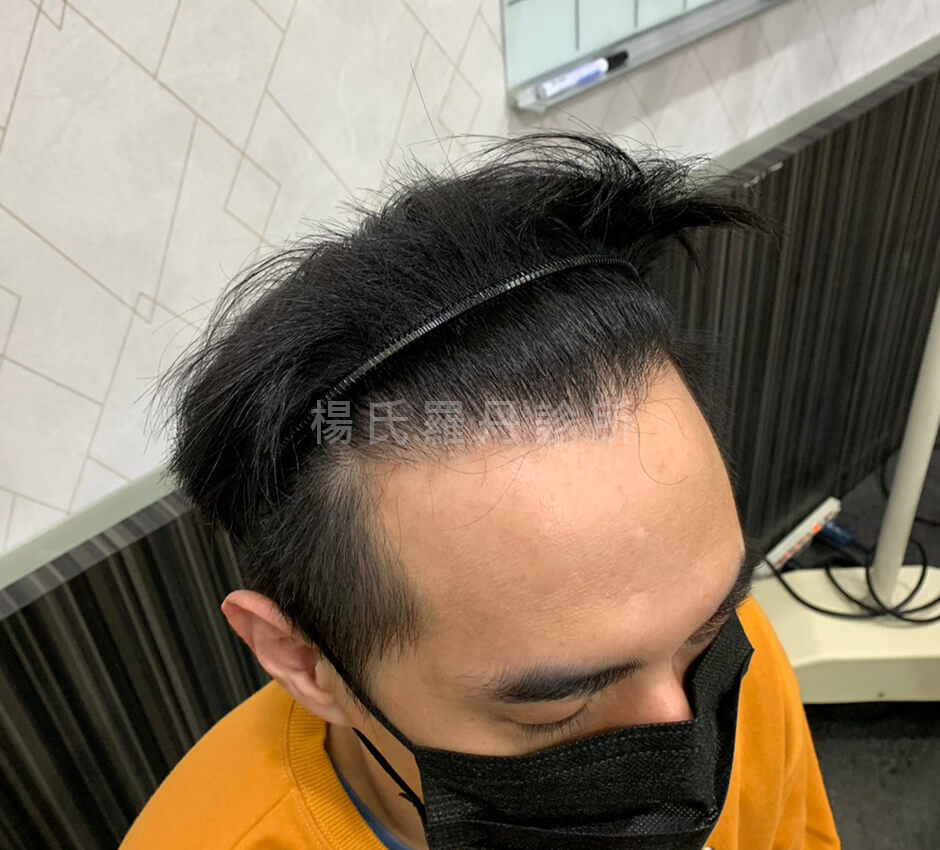植髮 髮際線 植髮效果
