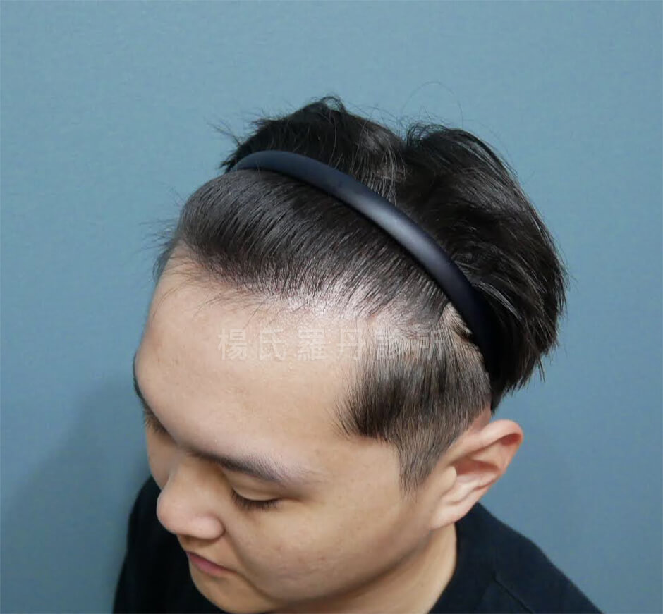 植髮 髮際線 植髮手術