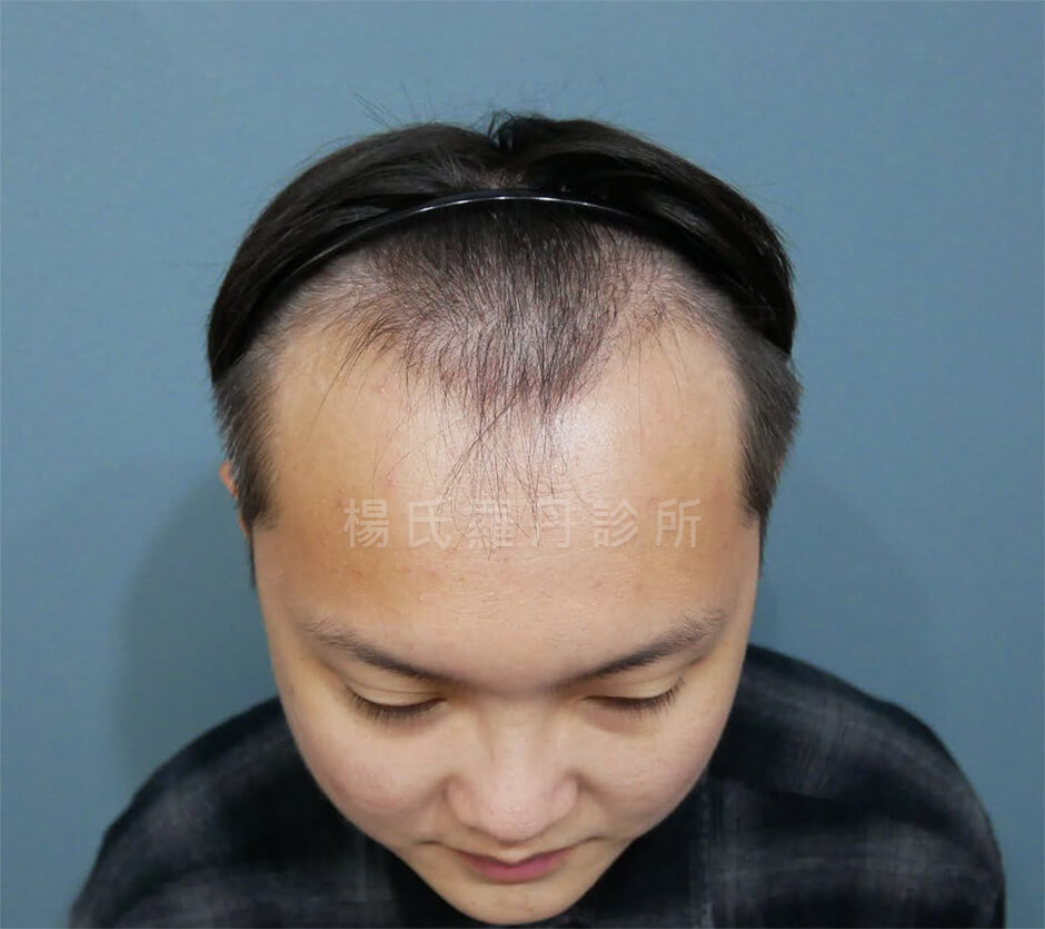 植髮 髮際線 植髮手術