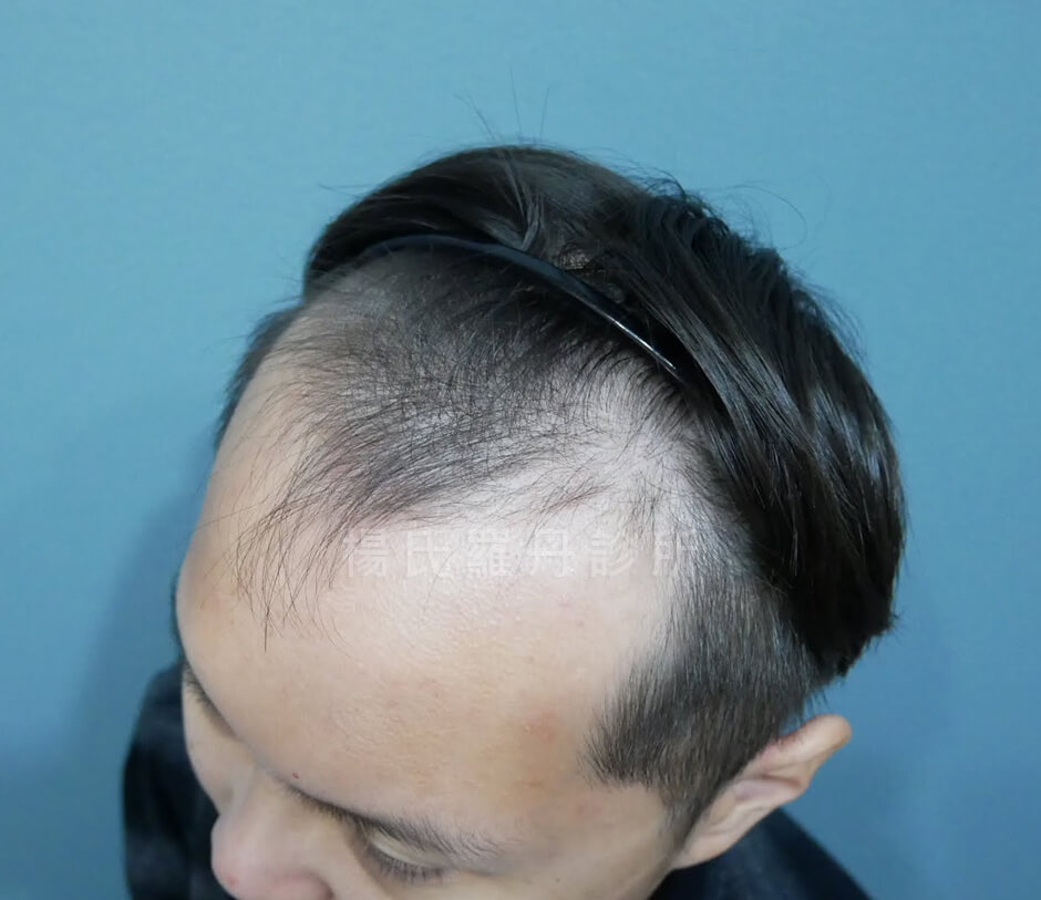 植髮 植髮手術 禿頭