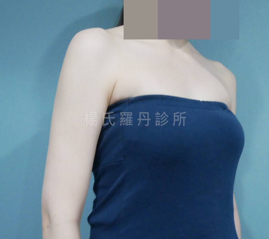 減脂 雷射減脂 雕塑