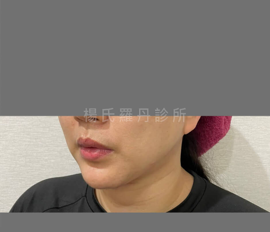 雷射減脂 減脂手術 輪廓線