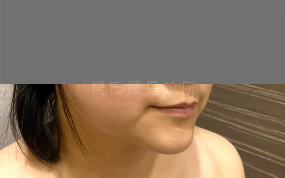 雷射減脂 減脂 下巴抽脂