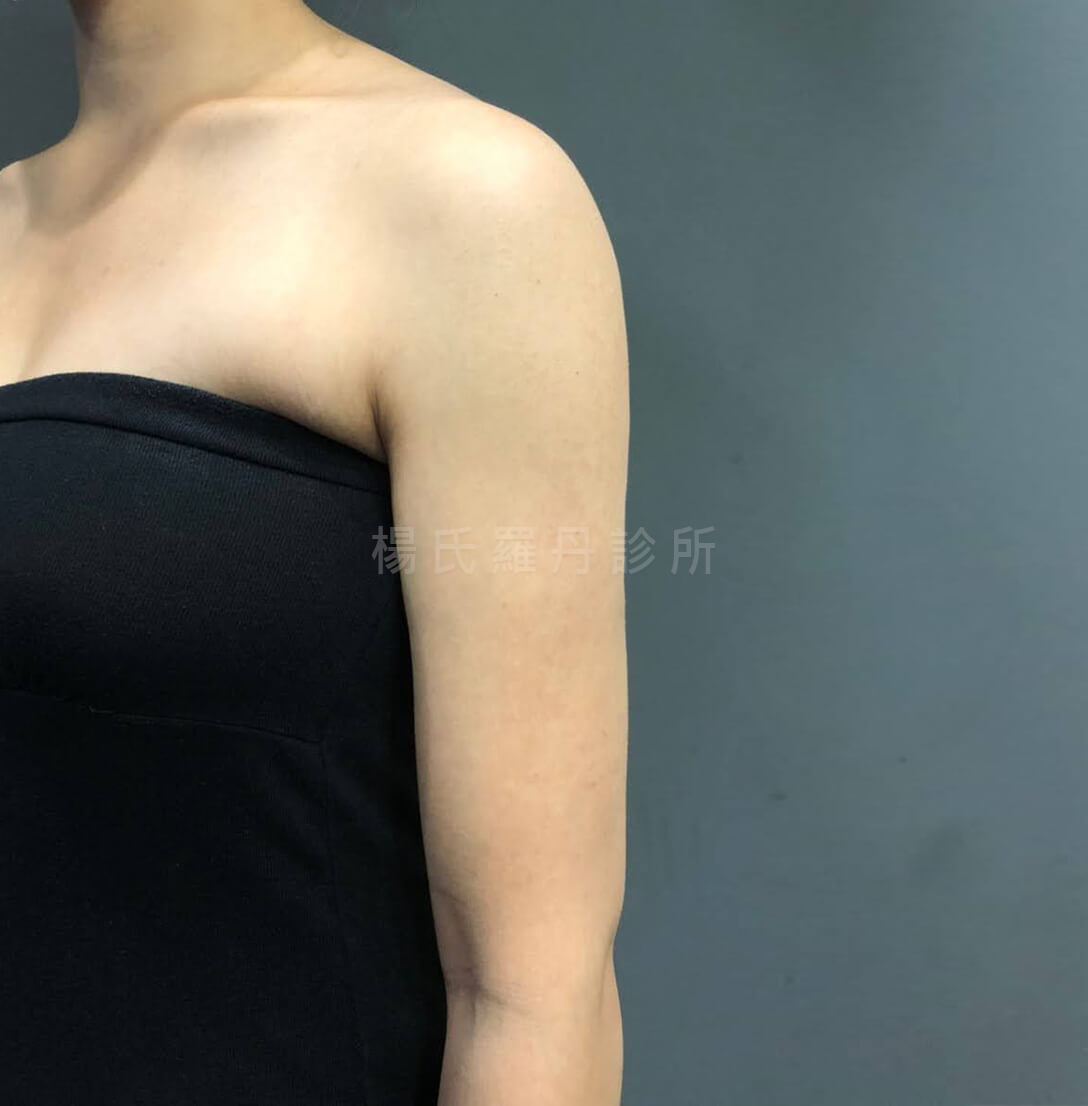 手臂抽脂 抽脂 雕塑