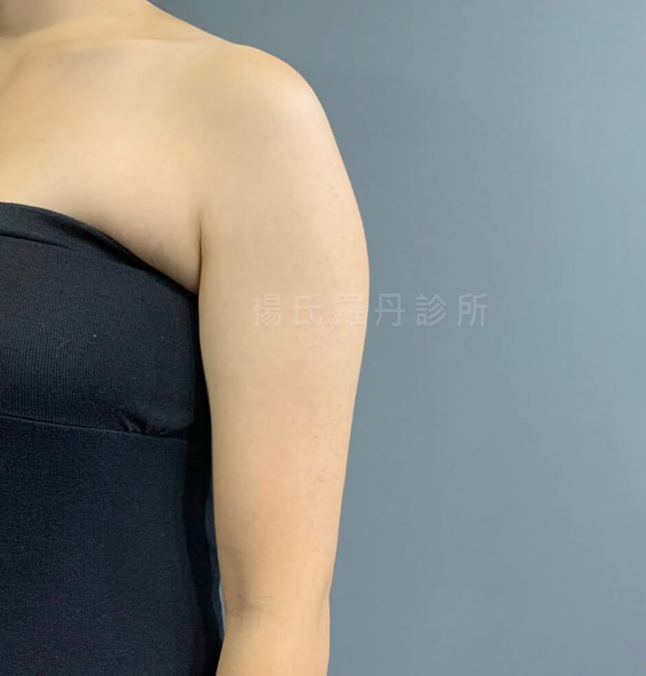 抽脂 手臂抽脂