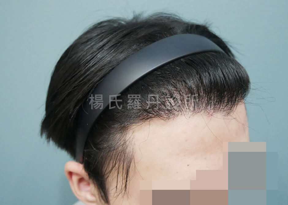 植髮 髮際線 植髮手術