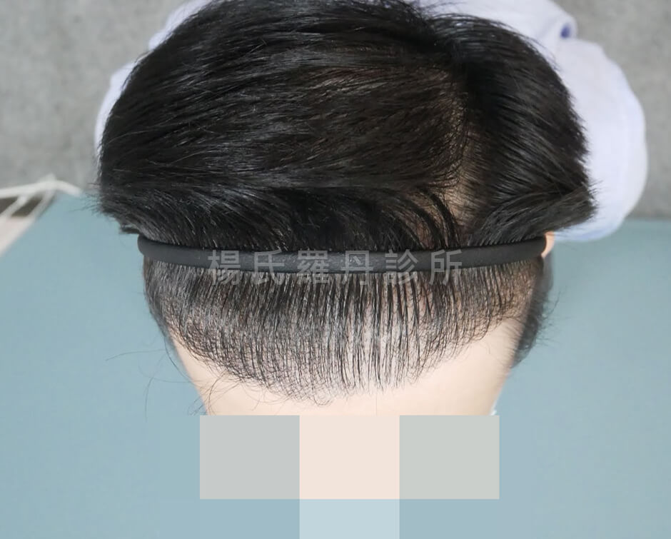 植髮 落髮