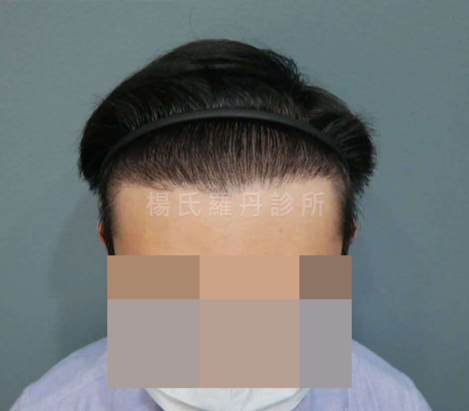 植髮 植髮手術
