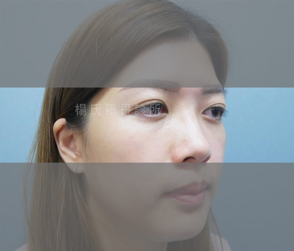 除眼袋 眼袋 眼袋手術