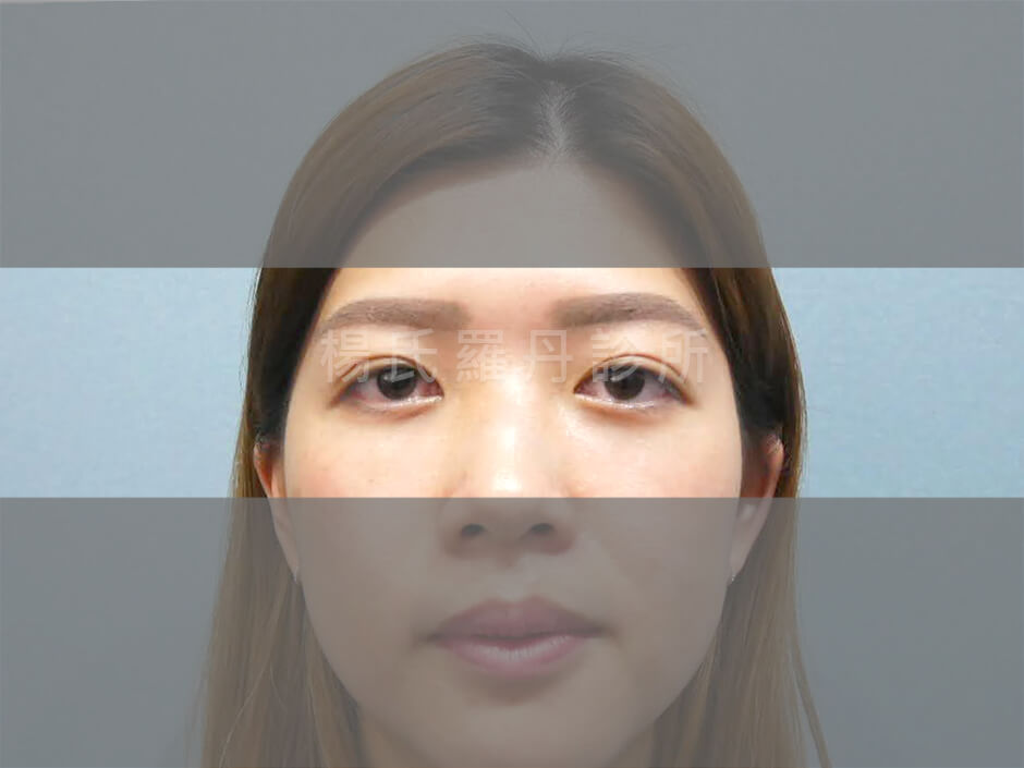 眼袋消除 眼袋 淚溝