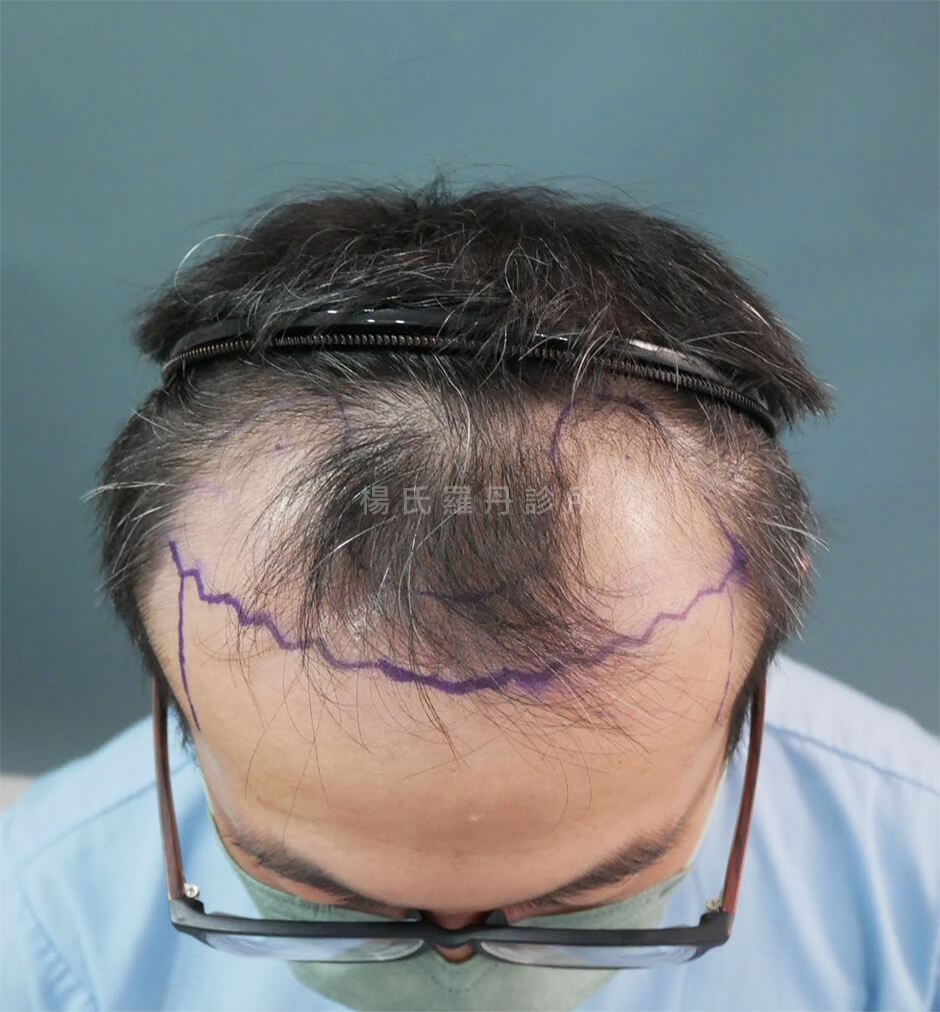 植髮 植髮手術 髮際線