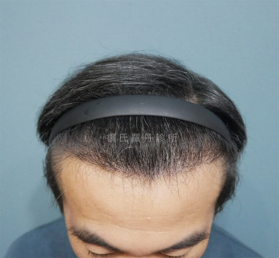 植髮 髮際線植髮