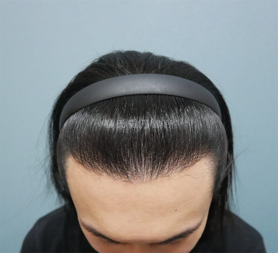 植髮 楊氏羅丹 髮際線