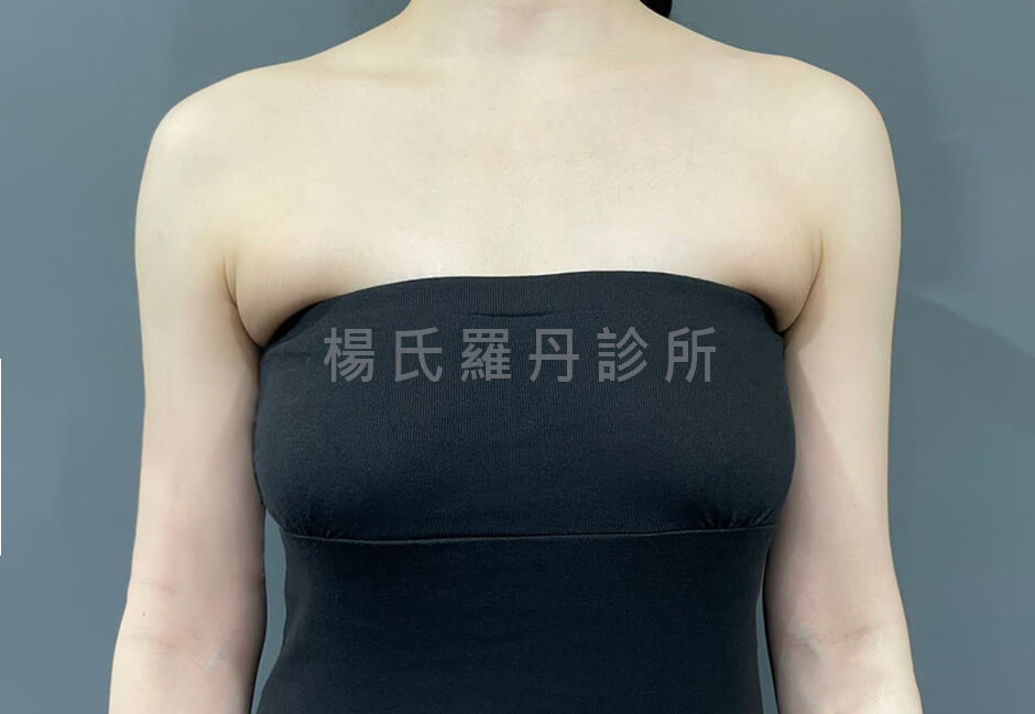 雷射減脂 蝴蝶袖