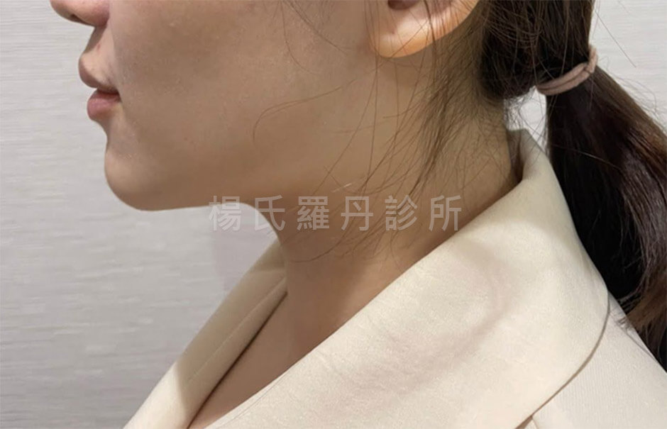 雷射減脂 瘦下巴