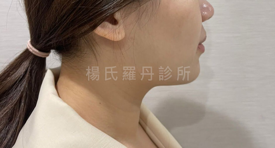 減脂 雷射減脂 雙下巴