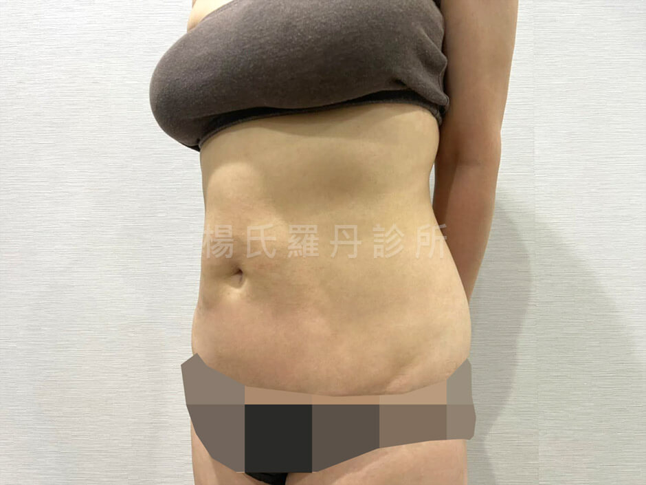 腹部抽脂 雷射減脂