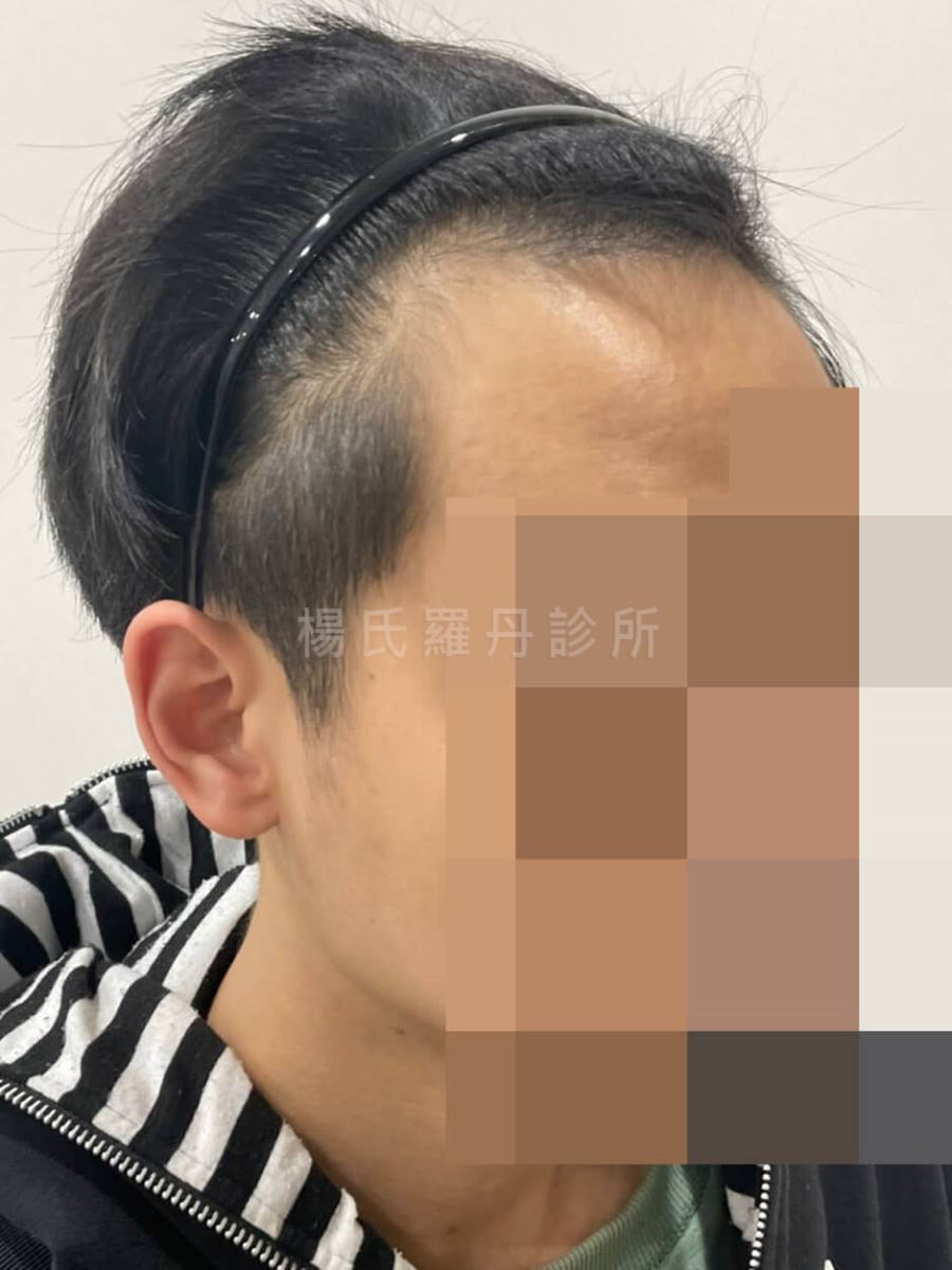 植髮 植髮手術