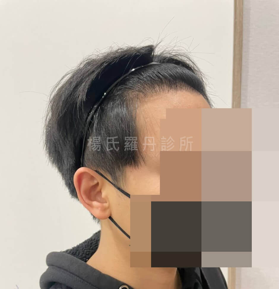 植髮 掉髮