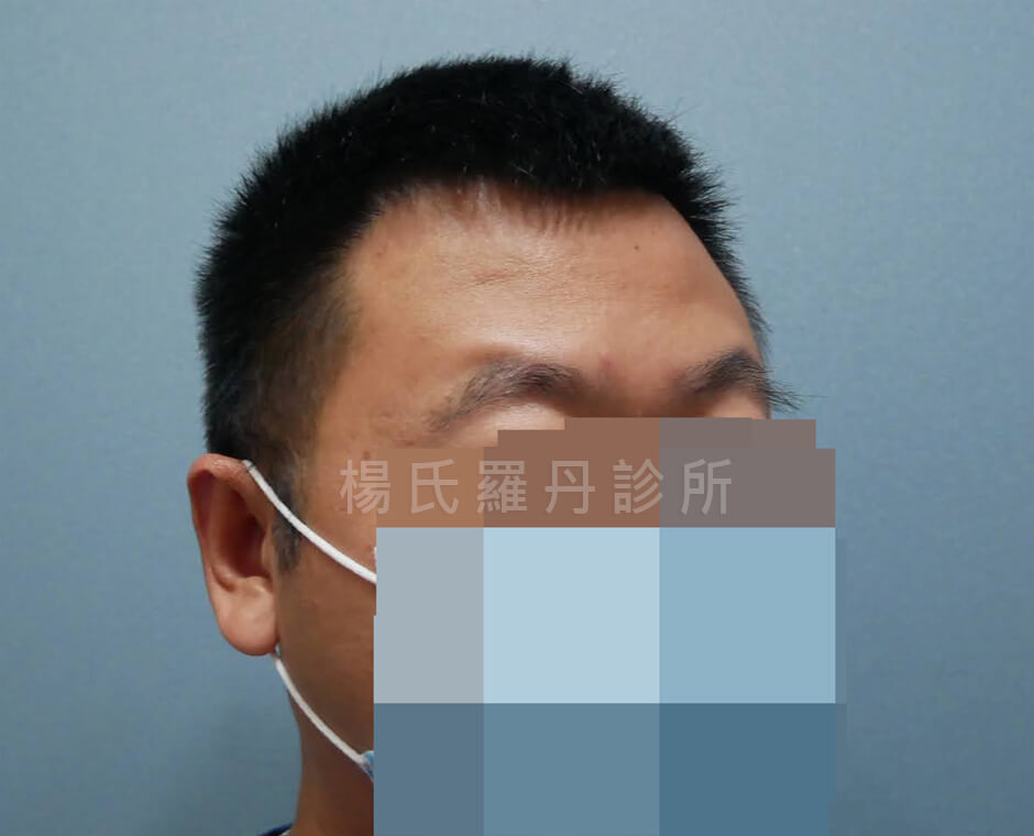 植髮 植髮手術