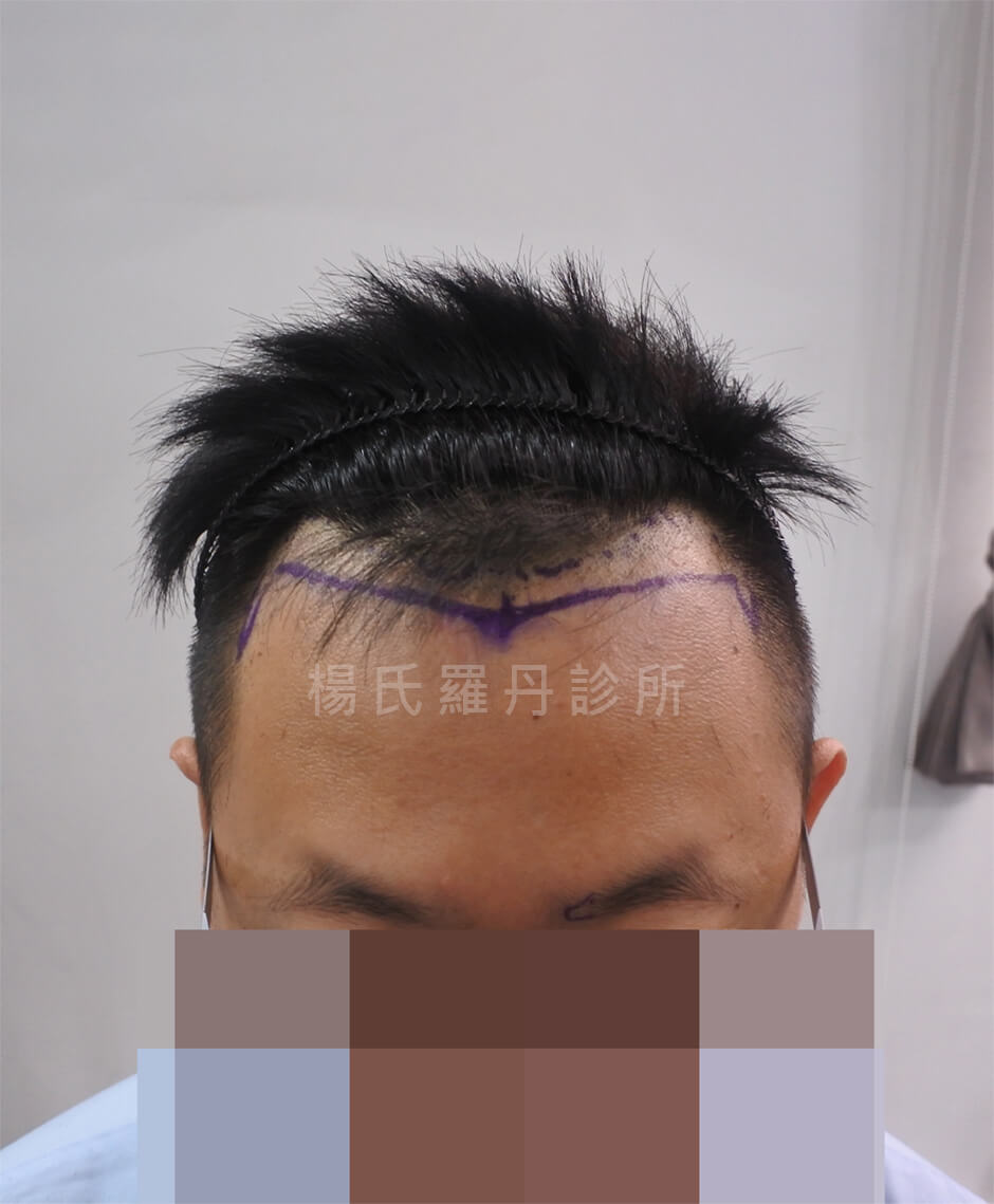 植髮 植眉 