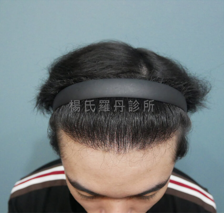 植髮 植髮成果