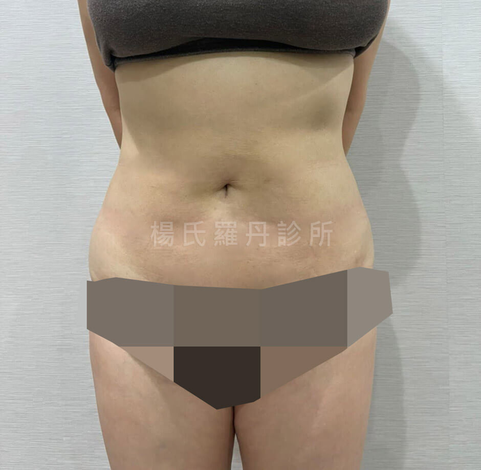 雷射減脂 減脂手術 瘦肚子