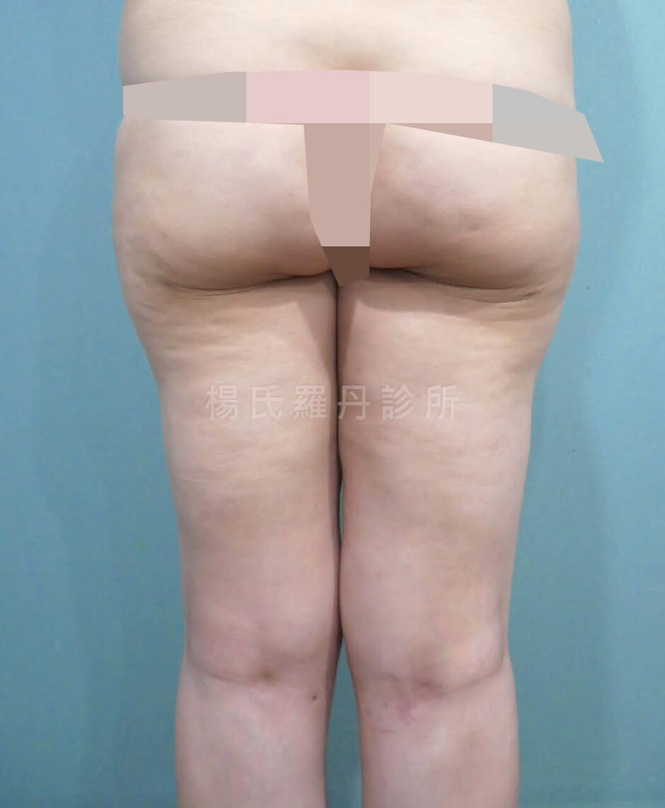 減脂 減脂手術 瘦大腿