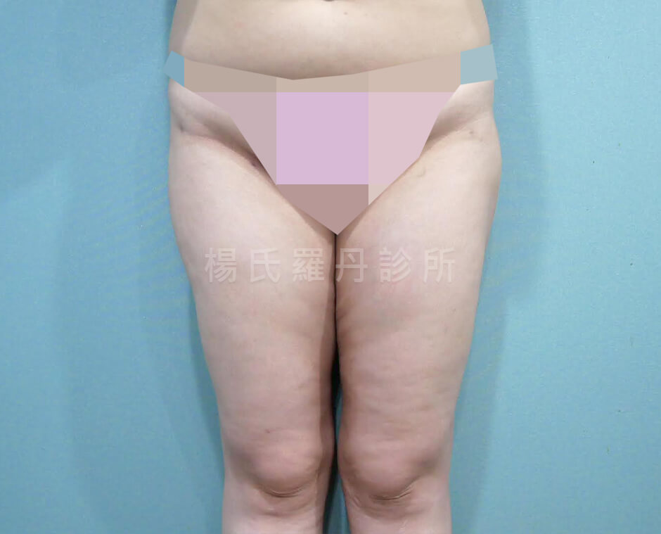 大腿環抽 抽脂 大腿抽脂