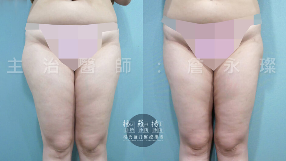 雷射減脂 大腿抽脂 雕塑