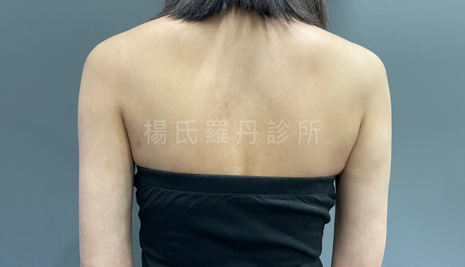 減脂 減脂手術 雕塑