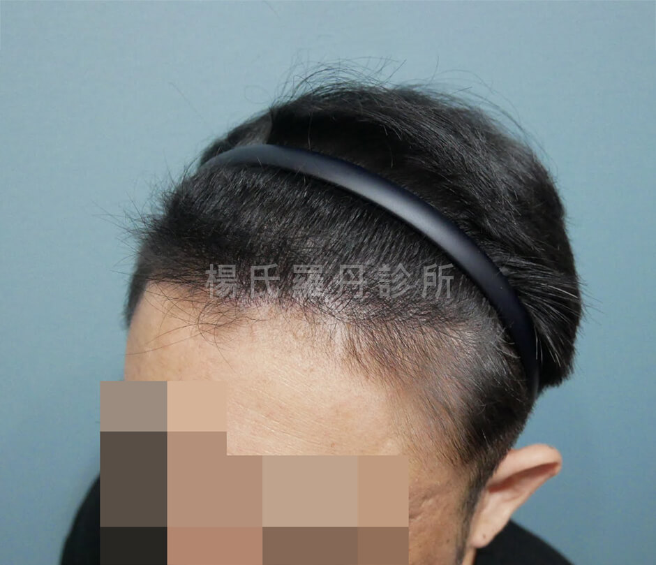 植髮 植髮手術