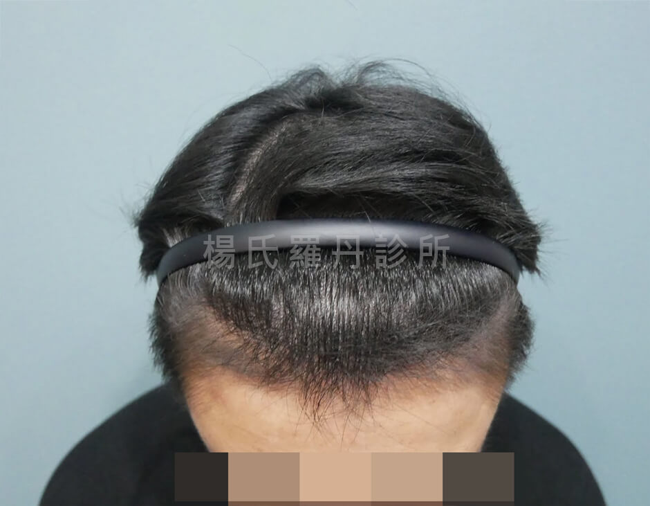 植髮 髮際線 