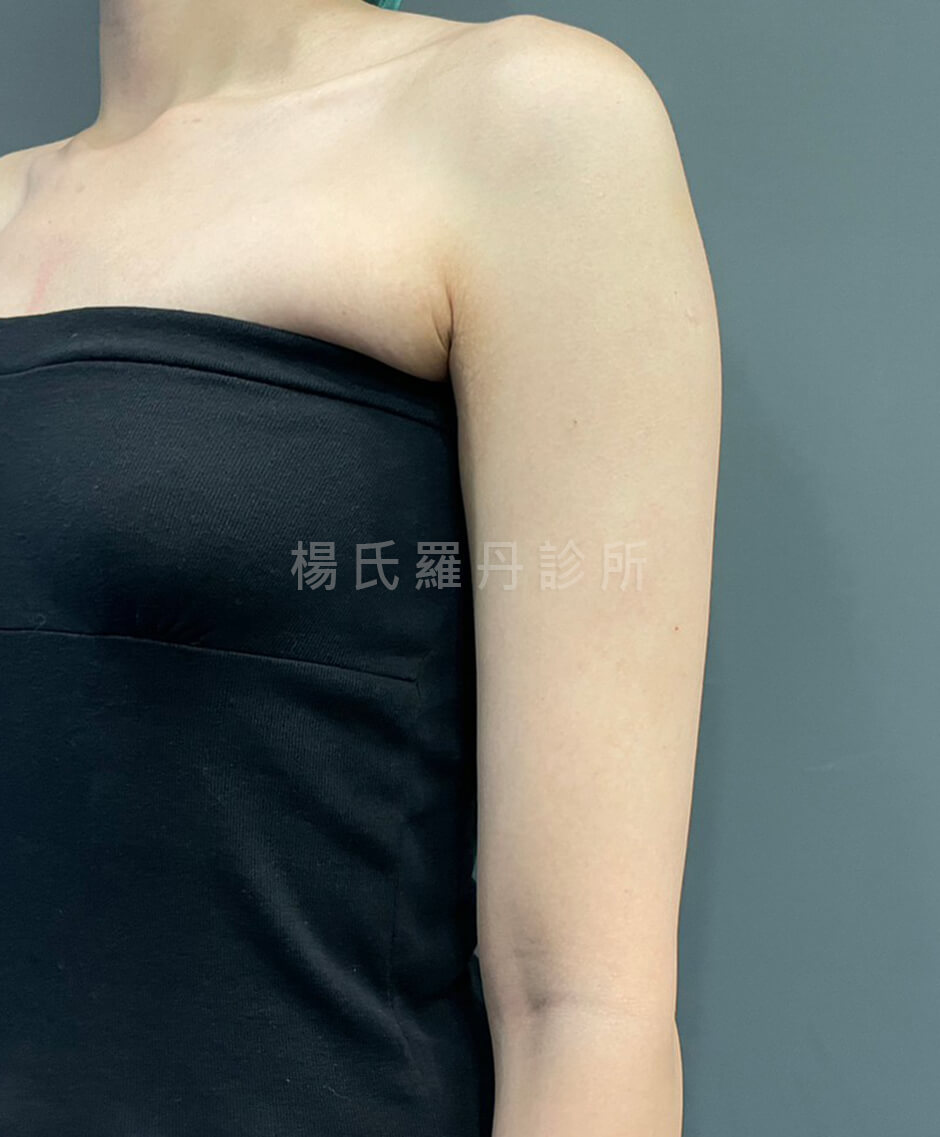 手臂抽脂 抽脂