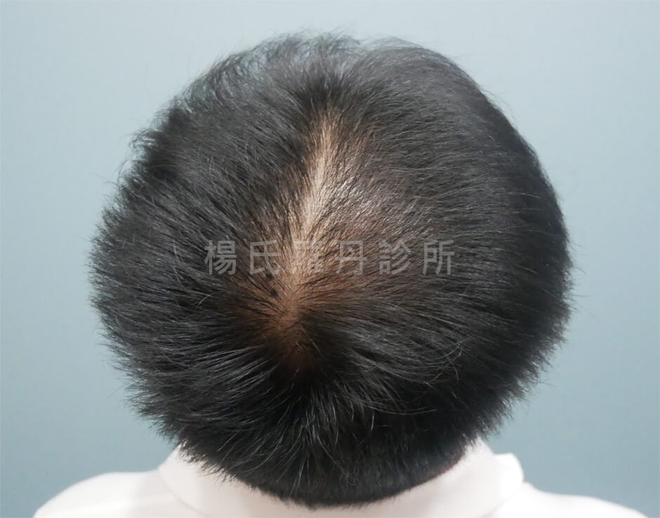 生髮 生髮效果 張泰山頭髮