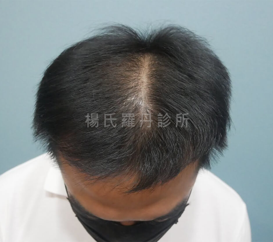 生髮 生髮療程 植髮 張泰山生髮