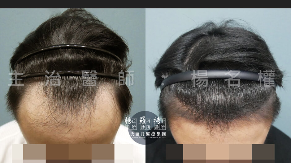 植髮 植髮手術 髮際線植髮