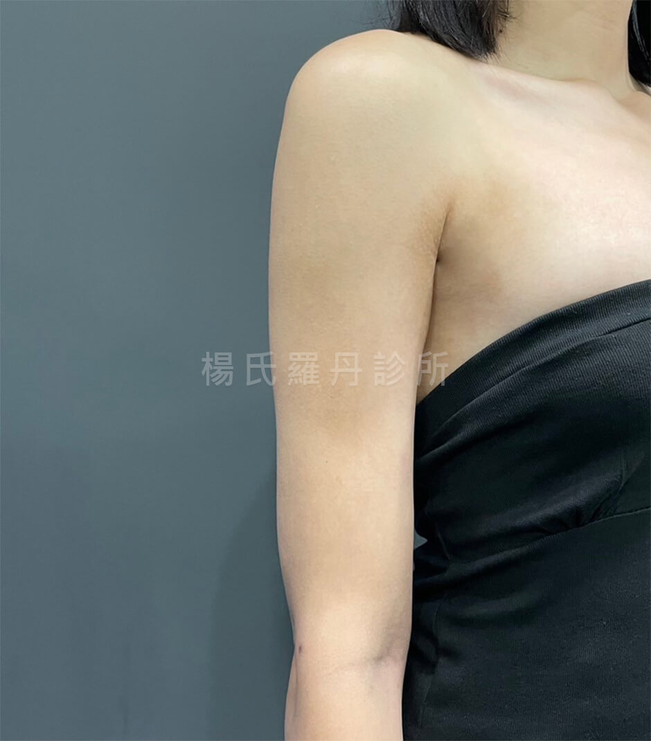 手臂抽脂 雷射減脂