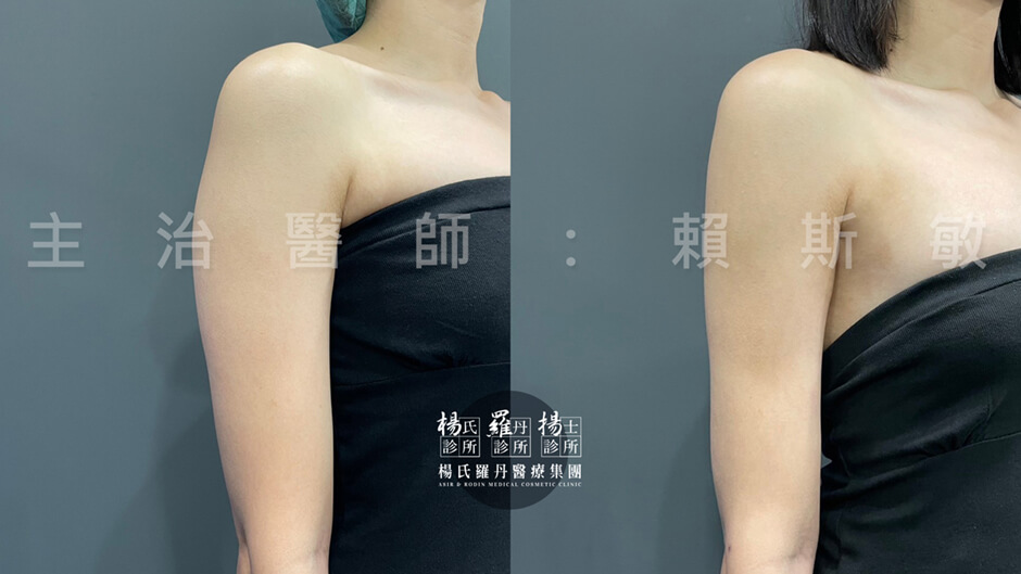 抽脂 雷射減脂 手臂抽脂 減脂