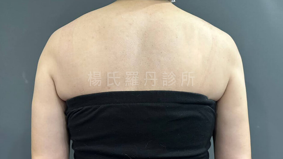 手臂抽脂 瘦手臂 抽脂