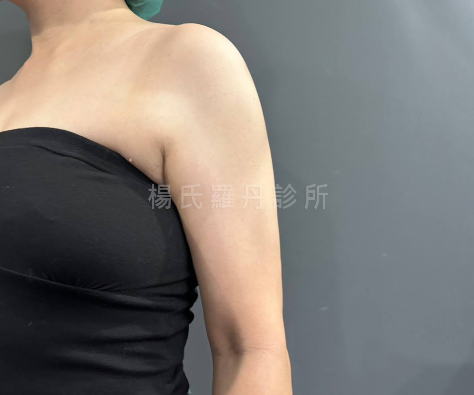 抽脂 減脂 雷射減脂