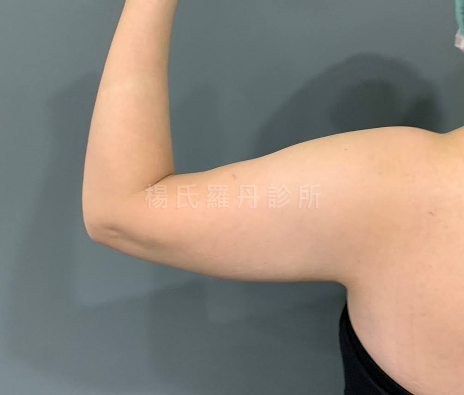 抽脂 瘦手臂 雷射減脂