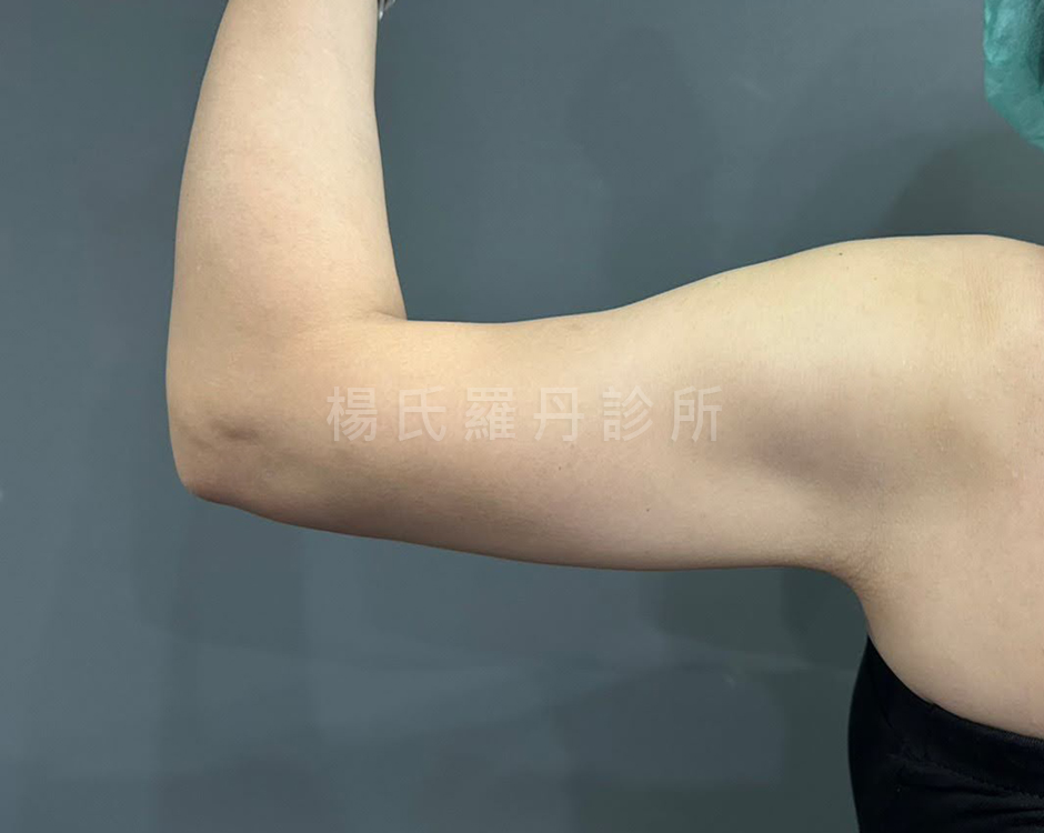 雷射減脂 抽脂 賴斯敏