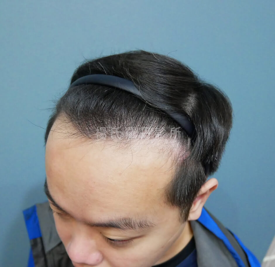 微創植髮 植髮 禿頭