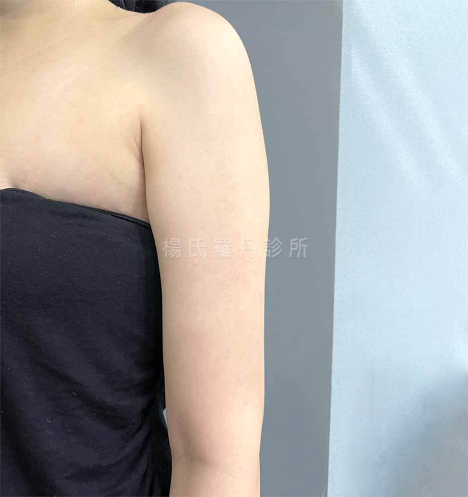 手臂抽脂 抽脂 瘦手臂