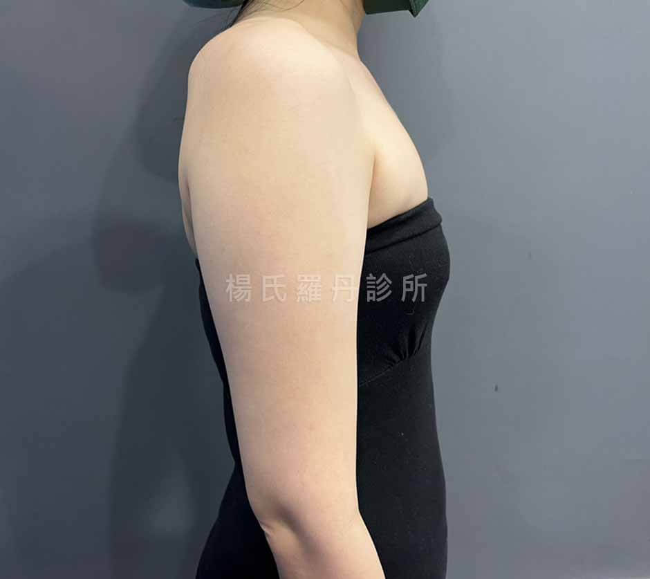 手臂抽脂 雷射減脂 雕塑