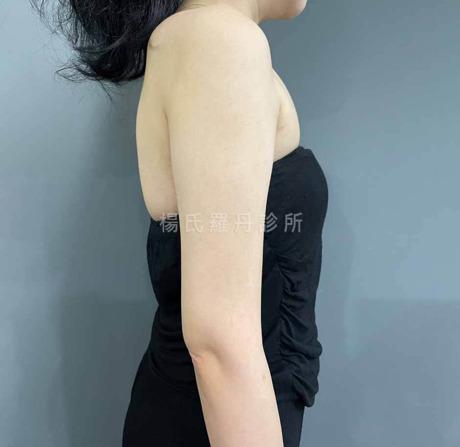 抽脂 雷射減脂 減脂手術