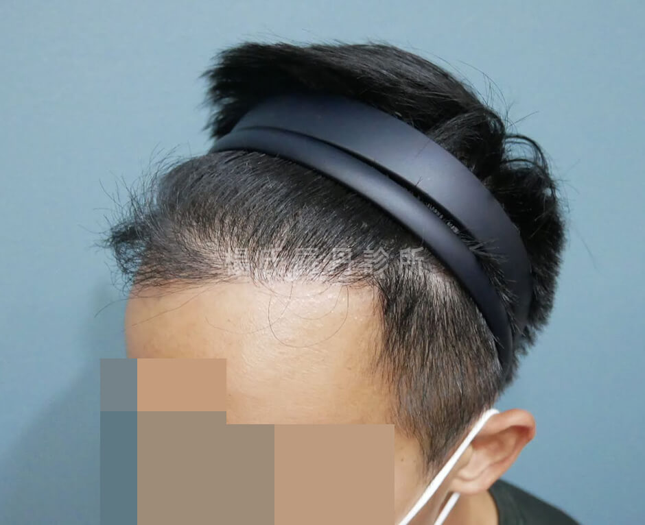 植髮 髮際線
